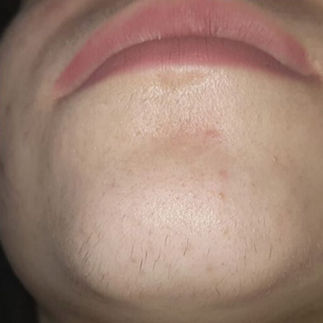 לפני טיפול בי סיגמה4